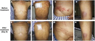 Venetoclax combined with azacitidine in blastic plasmacytoid dendritic cell neoplasm: a case report and comprehensive review on the current and future treatment